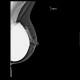Breast implants, mammography: MMG - Mammography
