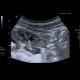 Gastroenteritis, acute, diarrhea: US - Ultrasound