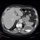 Pseudoaneurysm of aorta, replacement of ascending aorta, haemothorax: CT - Computed tomography