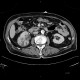 Pyelonephritis, kidney, follow-up: CT - Computed tomography
