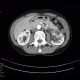 Pyelonephritis: CT - Computed tomography