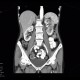 Pyelonephritis: CT - Computed tomography