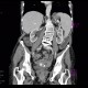 Pyometra, reactive changes of small bowel: CT - Computed tomography