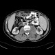 Neurofibromatosis, type I, von Recklinghausen disease, neurofibroma: CT - Computed tomography