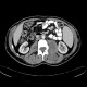 Neurofibromatosis, type I, von Recklinghausen disease, neurofibroma: CT - Computed tomography