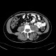 Neurofibromatosis, type I, von Recklinghausen disease, neurofibroma: CT - Computed tomography