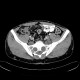 Neurofibromatosis, type I, von Recklinghausen disease, neurofibroma: CT - Computed tomography