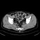 Neurofibromatosis, type I, von Recklinghausen disease, neurofibroma: CT - Computed tomography