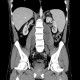 Neurofibromatosis, type I, von Recklinghausen disease, neurofibroma: CT - Computed tomography