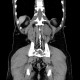 Neurofibromatosis, type I, von Recklinghausen disease, neurofibroma: CT - Computed tomography