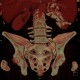 Neurofibromatosis, type I, von Recklinghausen disease, neurofibroma: CT - Computed tomography