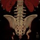 Neurofibromatosis, type I, von Recklinghausen disease, neurofibroma: CT - Computed tomography