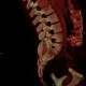 Neurofibromatosis, type I, von Recklinghausen disease, neurofibroma: CT - Computed tomography
