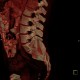 Neurofibromatosis, type I, von Recklinghausen disease, neurofibroma: CT - Computed tomography