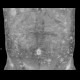 Neurofibromatosis, type I, von Recklinghausen disease, neurofibroma: CT - Computed tomography