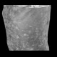 Neurofibromatosis, type I, von Recklinghausen disease, neurofibroma: CT - Computed tomography
