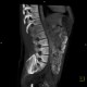 Neurofibromatosis, type I, von Recklinghausen disease, neurofibroma: CT - Computed tomography
