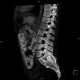 Neurofibromatosis, type I, von Recklinghausen disease, neurofibroma: CT - Computed tomography