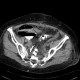 Rectovaginal fistula: CT - Computed tomography