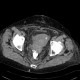 Rectovaginal fistula: CT - Computed tomography