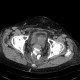 Rectovaginal fistula: CT - Computed tomography