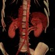 Retroaortic renal vein, duplication of renal vein, VRT: CT - Computed tomography