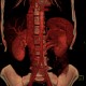 Retroaortic renal vein, duplication of renal vein, VRT: CT - Computed tomography