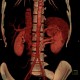 Retroaortic renal vein, duplication of renal vein, VRT: CT - Computed tomography