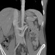 Retroaortic renal vein, duplication of renal vein: CT - Computed tomography