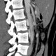 Retroaortic renal vein, duplication of renal vein: CT - Computed tomography