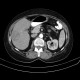 Liver metastasis, RFA, radiofrequency ablation of metastasis, before: CT - Computed tomography