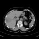 Liver metastasis, RFA, radiofrequency ablation of metastasis, before: CT - Computed tomography