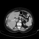 Liver metastasis, RFA, radiofrequency ablation of metastasis, after RFA: CT - Computed tomography