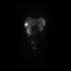 Liver metastasis, RFA, radiofrequency ablation of metastasis: NM - Nuclear medicine