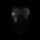 Liver metastasis, RFA, radiofrequency ablation of metastasis: NM - Nuclear medicine
