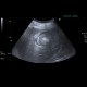 Liver metastasis, RFA, radiofrequency ablation of metastasis: US - Ultrasound