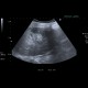 Liver metastasis, RFA, radiofrequency ablation of metastasis: US - Ultrasound