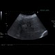Liver metastasis, RFA, radiofrequency ablation of metastasis: US - Ultrasound