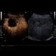 Liver metastasis, RFA, radiofrequency ablation of metastasis, CEUS: US - Ultrasound