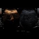 Liver metastasis, RFA, radiofrequency ablation of metastasis, CEUS: US - Ultrasound