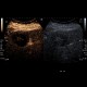 Liver metastasis, RFA, radiofrequency ablation of metastasis, CEUS: US - Ultrasound