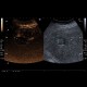 Liver metastasis, RFA, radiofrequency ablation of metastasis, CEUS: US - Ultrasound
