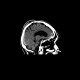 Contusion of frontopolar cortex, beam hardening artifact, subarachonid hemorrhage, follow-up: CT - Computed tomography
