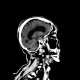 Contusion of frontopolar cortex, beam hardening artifact, subarachonid hemorrhage, initial scan: CT - Computed tomography
