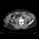 RTA, pneumothorax, subcutaneous emphysema, soft tissue damage, fracture of iliac crest, rib fracture: CT - Computed tomography