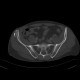 RTA, pneumothorax, subcutaneous emphysema, soft tissue damage, fracture of iliac crest, rib fracture: CT - Computed tomography