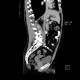 Rudimentary uterus: CT - Computed tomography