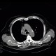 Atelectasis of right upper lobe of lung: CT - Computed tomography