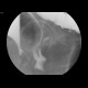 Rectovaginal fistula, diverticular disease of the sigmoid colon: RF - Fluoroscopy