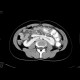 Ren arcuatus: CT - Computed tomography